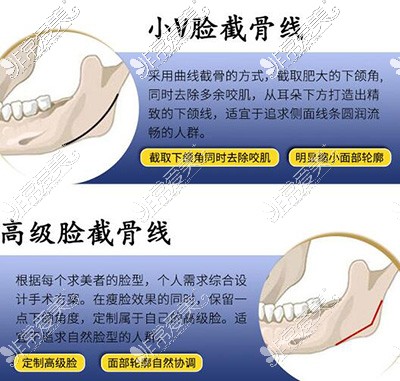 郑州磨骨瘦脸手术价格表公布,包括下颌角颧骨各部位费用!