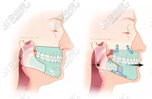 正颌手术示意图