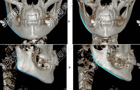 下颌角截骨前后CT图片对比