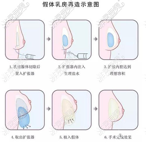 假体植入乳房再造术过程