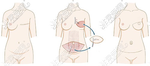 腰腹自体组织移植乳房再造术