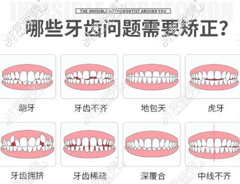 哪些牙齿需要做正畸改善