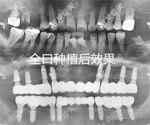 全口连桥冠种植修复