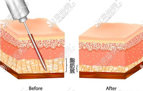 吸脂原理示意圖