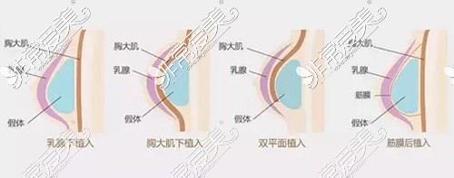 双平面假体丰胸示意图