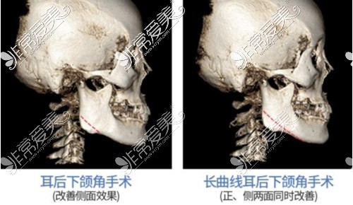 苏州下颌角手术哪能做?揭秘当地做面部轮廓手术好的医生!