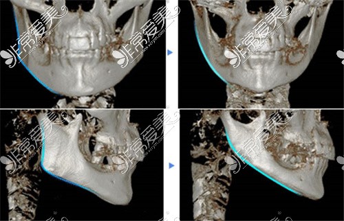 武汉亚韩整形外科医院下颌角CT对比