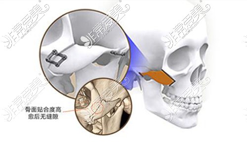 颧骨整形双端固定技术