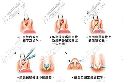 鼻綜合示意圖