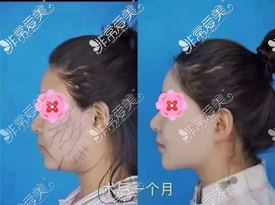 揚(yáng)州施爾美整形外科面部吸脂<span style=