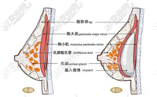 隆胸示意圖