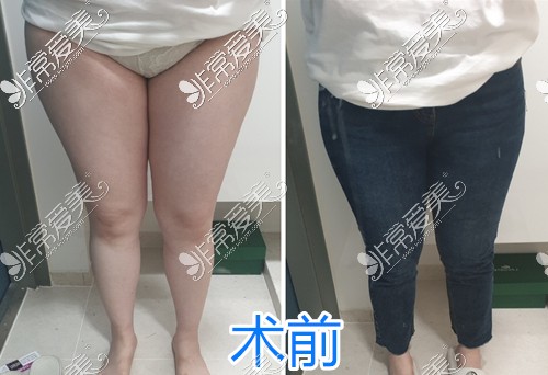 韩国梦线整形大腿臀部吸脂术前图分享
