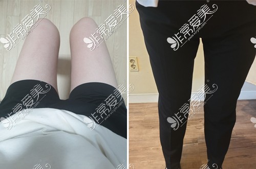 韩国梦线整形大腿臀部吸脂术后两个月