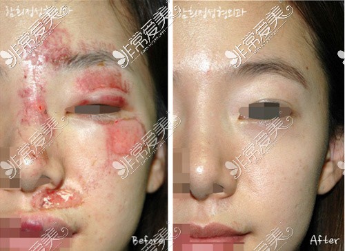 韩国Dr.hams整形医院烧伤疤痕修复对比