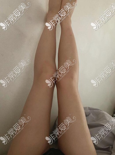 韩国梦线整形医院大腿吸脂两个月照片