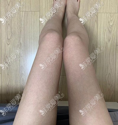 韩国梦线大腿吸脂六个月效果