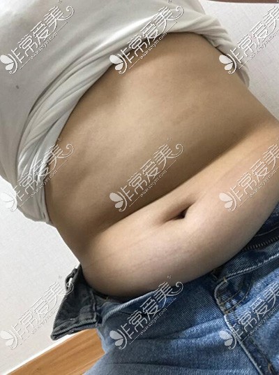 韩国梦线整形外科腰腹吸脂术前