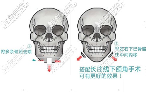 下巴整形改善卡通图