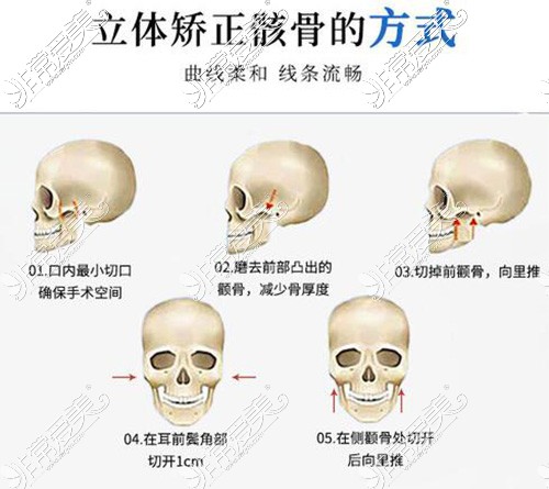 赵绛波颧骨手术怎么样?公布多组赵绛波磨骨日记看真实效果!