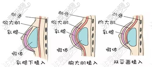 双平面假体丰胸示意图