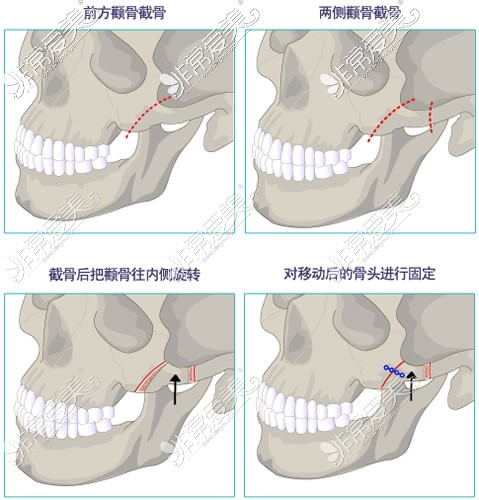 北京何照华医生做颧骨缩小手术细节展示