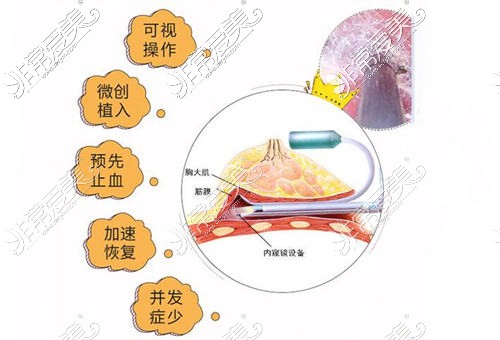 荔湾区隆胸内视化操作