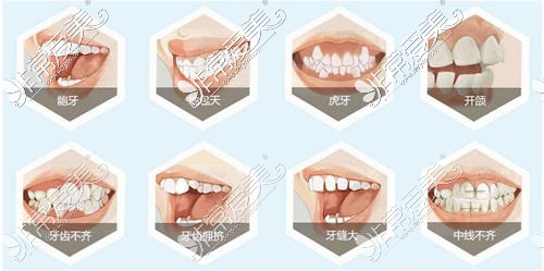需要做牙齿矫正的几种情况