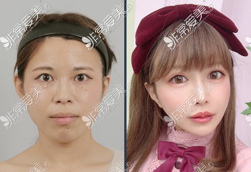 韩国ID医院双颚整形前后对比