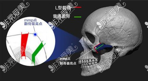 佛山颧骨整形价钱要多少,揭秘颧弓缩小颧骨降低各项费用!