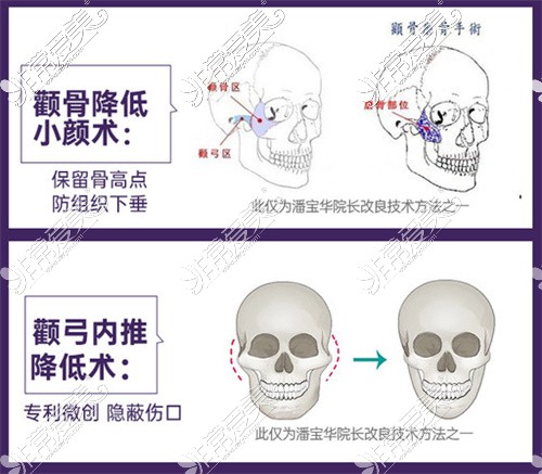 重庆改脸型手术多少钱？这份重庆磨骨手术费价格表请收好!