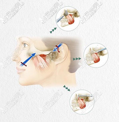 一针降颧骨卡通示意图