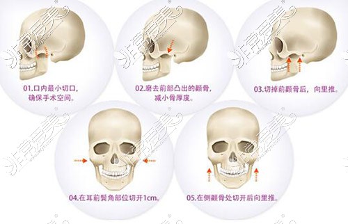 颧骨缩小手术卡通图