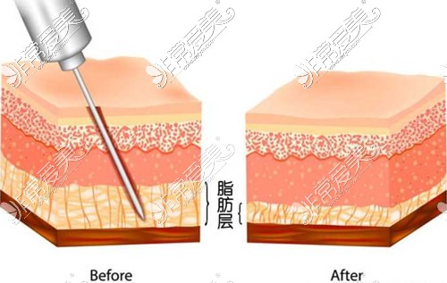 苏州大腿吸脂哪些医院做的好？这些医院腿部减脂效果好！