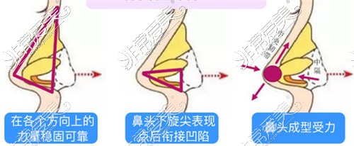 张磊医生隆鼻技术