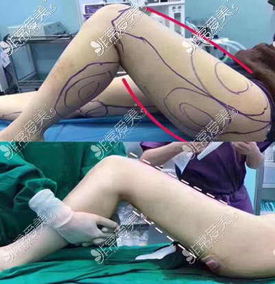 上海佳富美大腿吸脂对比