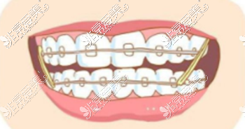 牙齿矫正小皮筋佩戴部位