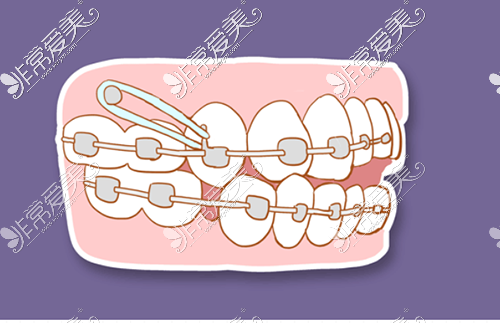 皮筋在矫正牙齿中的作用