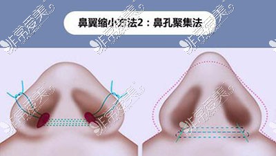 鼻翼整形手术卡通图