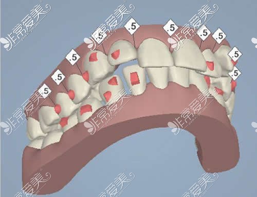 隐形牙套矫正牙齿原理分析