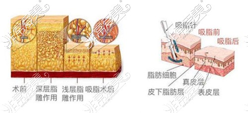 南京抽脂哪家医院好?吸脂姐妹告诉你南京抽脂哪里好!