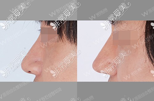 韩国原辰整形医院鼻部整形示意图