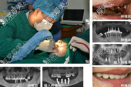 昆明种植牙多少价格一颗?曝光当地正规口腔医院种牙价格!
