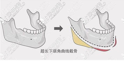 下頜角整形手術(shù)