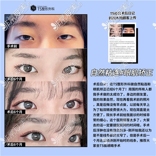 韩国TS整形医院眼部整形效果 韩国TS整形医院眼部整形效果