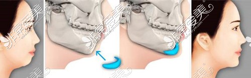 成都军大整形医院假体垫下巴植入层次
