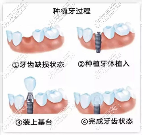 种植牙过程