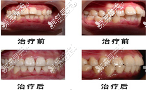 矫正对比