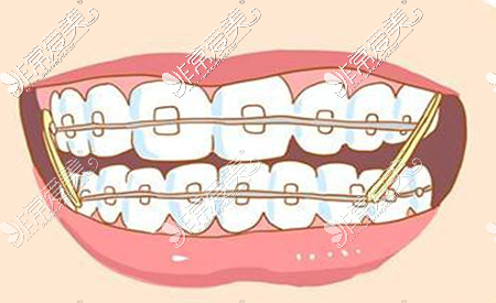 正畸后牙齿可以一辈子都保持整齐吗 其实反弹也是看情况！