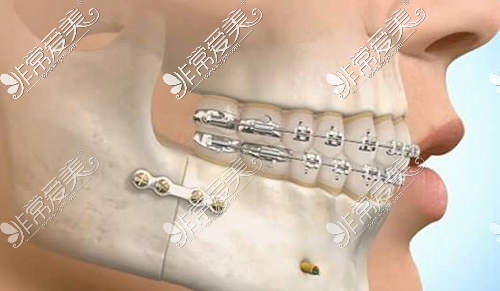 牙齿矫正牙套剖析图