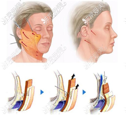 上海悦目佳容整形医院小切口拉皮分层提拉
